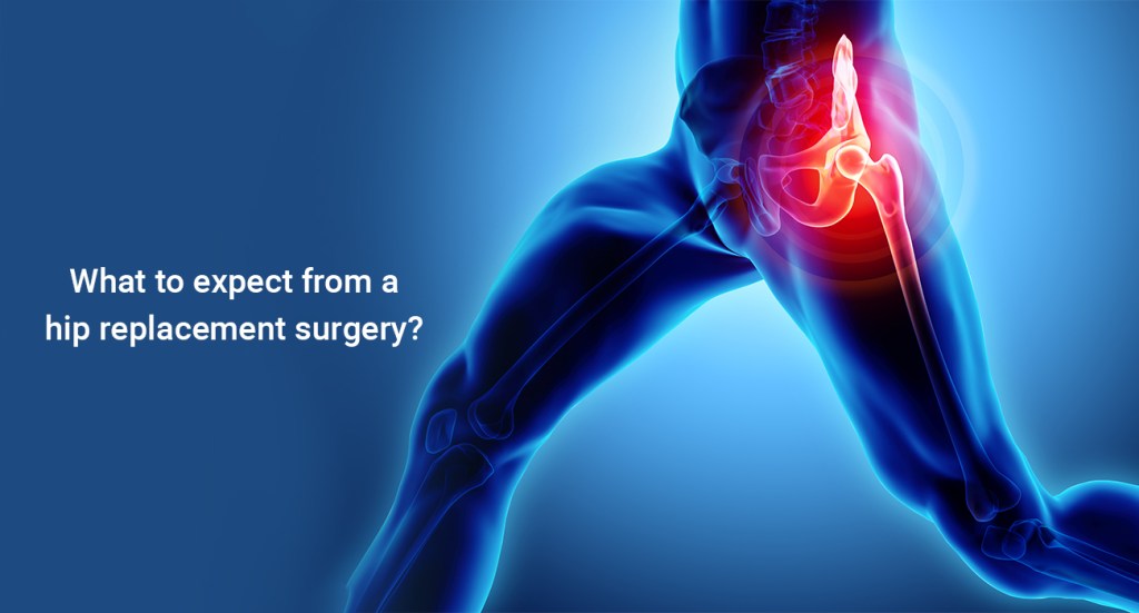 Hip Replacement Surgery in moti nagar